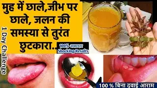 मुंह के छाले, Mouth Ulcer को 1 ही जड़ से ठीक करने के रामबाण उपाय- Mouth Ulcer- Muh ke chhale ka ilaj