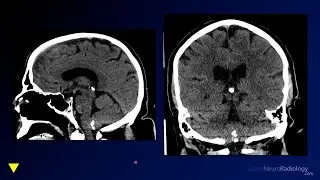 Neuroradiology Board Review - Brain Tumors - Case 15