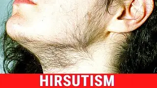 What is Hirsutism? Symptoms, Causes, Treatment