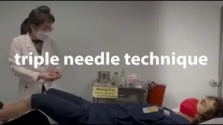 triple needling method [acupuncture | traditional eastern medicine | dongguk university los angeles]