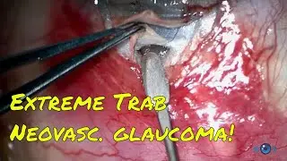 Glaucoma Sessions Part II - Extreme trabeculectomy surgery with anti-VEGF for neovascular glaucoma