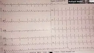 ECG cases by Dr. A. M. Shafique sir