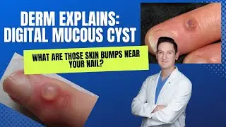 Doctor explains: DIGITAL MUCOUS CYSTS #digitalmucouscyst #cyst #whatsonmyskin