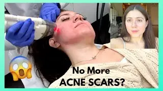 ACNE SCAR REMOVAL (with pictures) (FRAXEL LASER)