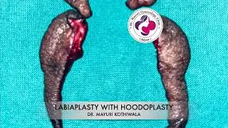 Labiaplasty Surgery | Designer Vagina | Labia Minora Reshaping