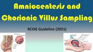 Amniocentesis and Chorionic Villus Sampling, RCOG Guideline (2021)