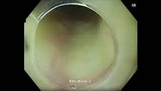 Peroral endoscopic myotomy (POEM) - Identifying Deep vessels with RDI Mode2