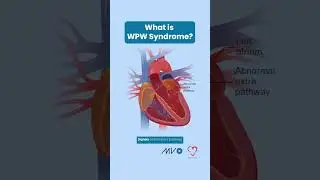Wolff-Parkinson-White (WPW) Syndrome ⚡️💓