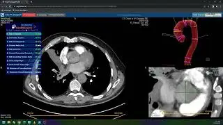 Trauma to Lung & Thyroid Nodules   2023 RSNA Imaging AI in Practice Demo