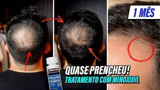 1 mês de MINOXIDIL | Projeto EX CALVO | O MELHOR tratamento para queda de cabelo🧔🏻