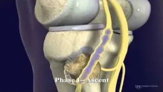 Peroneal and Tibial Intraneural Ganglion Cysts in the Knee Region: Video 1