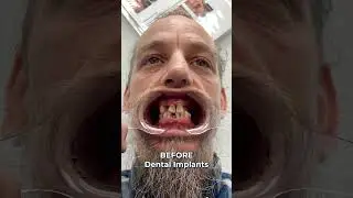 Before And After Smile Transformation! 🤯 Full Mouth Dental Implants! 🦷✨ 