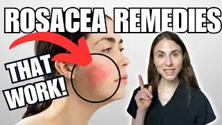 5 Rosacea Remedies THAT WORK | Dermatologist Tips