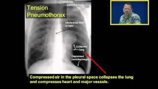 Tension Pneumothorax: Introduction to Chest Tubes