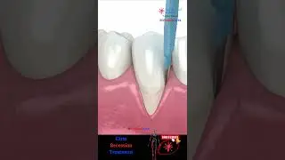 Gum Graft Surgery 🦷 Gum Recession Treatments 😷