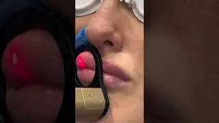 Wrinkle Free Lips with CO2 Resurfacing Laser | Dr. Medispa