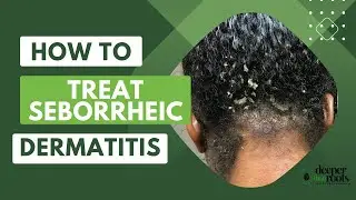 How to treat Seborrheic Dermatitis @deeperthanrootsscalpcare