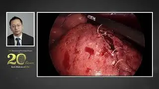 Fetal Surgery for Myelomeningocele