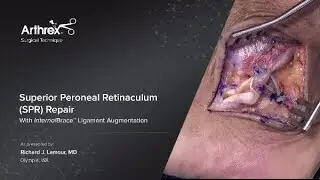 Superior Peroneal Retinaculum (SPR) Repair With InternalBrace™ Ligament Augmentation