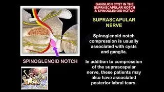 Ganglion Cyst Of The Shoulder - Everything You Need To Know - Dr. Nabil Ebraheim