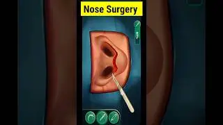 Nose Surgery/rhinoplasty 3D #shortvideo #shorts #short