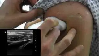 Shoulder Dislocation Ultrasound from One Minute Ultrasound