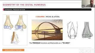 Distal Humerus Fractures