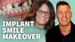 🤯 Implant Smile Makeover - Is It Really Possible to SMILE AGAIN?