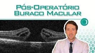 Buraco Macular: pós-operatório.