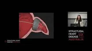 Procedural TOE Guidance for Left Atrial Appendage Occlusion - Dr Julie Humphries