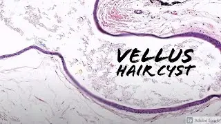 Vellus Hair Cyst: 5-Minute Pathology Pearls