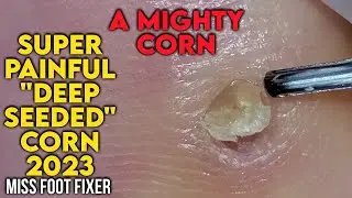 SUPER PAINFUL " DEEP SEEDED CORN" 2023 [ A MIGHTY CORN] BY MISS FOOT FIXER