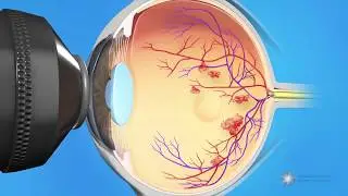 Combined Injection and Laser Treatment for Macular Edema