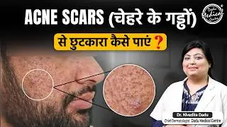 How to Treat Acne Scars? | Acne Scar Treatments: Laser, MNRF, PRP | Patient's Journey at DMC