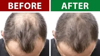 7 Home Remedies to Prevent Hair Loss and Regrow Your Hair