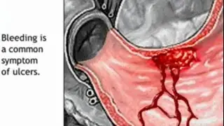 Stomach Ulcer Animation - Peptic Ulcer Disease Causes, Symptoms, Treatment - Gastric Anatomy