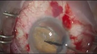 Severe traumatic cataract dislocation, atonic pupil and glaucoma