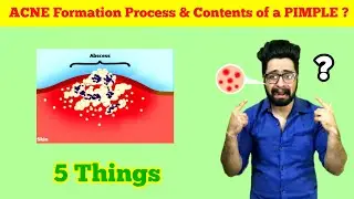 The Process of ACNE FORMATION & 5 Contents of a PIMPLE | 