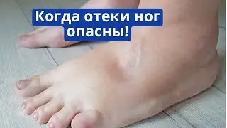 Когда отеки ног опасны?