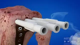 3D Medical Animation San Antonio Orthopedic Surgical Illustration surgical animation company