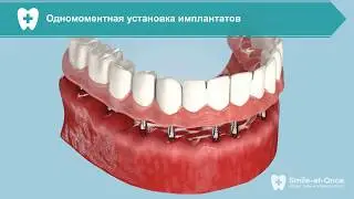 Лечение пародонтоза при помощи имплантации за 3 дня