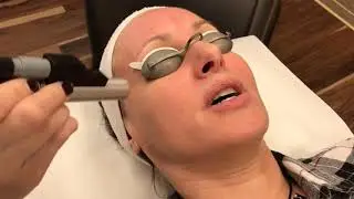 LaserFACIAL at YOUN Plastic Surgery - Dr  Anthony Youn