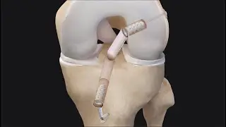 BTB ACL Reconstruction Using BioComposite FastThread™ Interference Screws and the FiberTape® Button