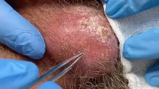 Drainage of an infected cyst under the chin