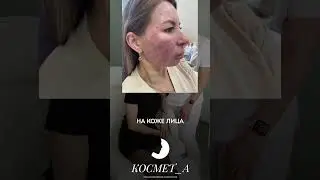 ПРОБЛЕМВ С КОЖЕЙ В 41😨 миф или реальность?