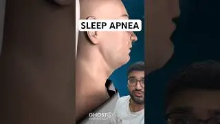 Doctor Explains Why People Stop Breathing At Night