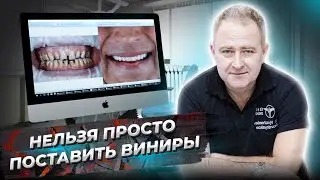 НЕЛЬЗЯ просто поставить ВИНИРЫ. ЧТО НУЖНО сделать перед установкой виниров. Установка виниров (16+)