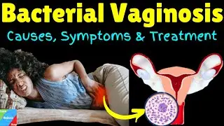 Bacterial Vaginosis (BV) – Symptoms, Causes, Diagnosis & Treatment