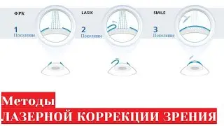Лазерная коррекция зрения - обзор методов ФРК, LASIK, ReLEx SMILE