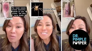 Lets talk about Loxoceles reclusa! A type of spider whose bite cause tissue necrosis